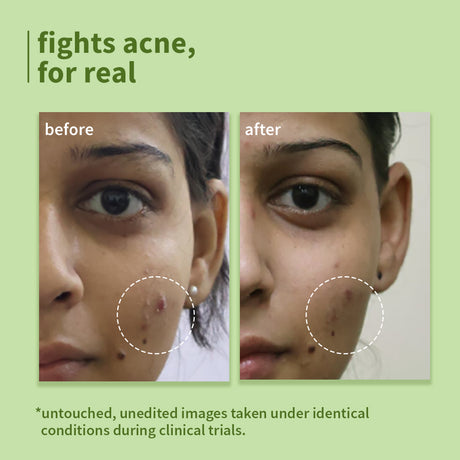 Green Tea Pore Cleansing Face Wash for Acne